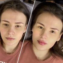 Услуги косметолога./Увеличение губ / Все техники, Подольск