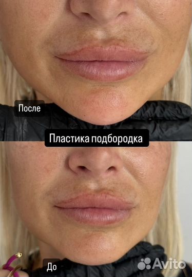 Контурная пластика подбородка