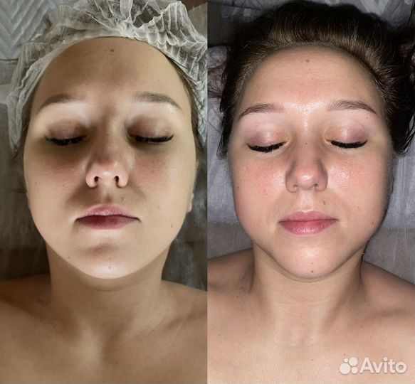 Массаж лица