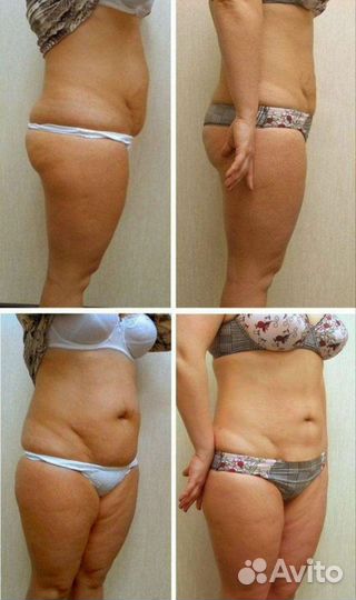 Модель на криолиполиз