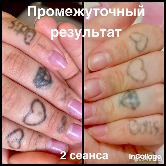 Удаление тату, татуажа, карбоновый пилинг