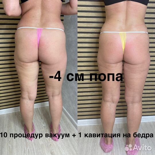 Аппаратная коррекция фигуры и лица