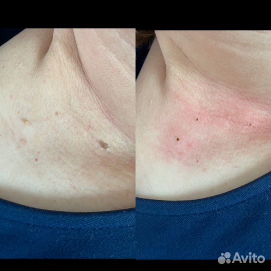 Удаление папиллом