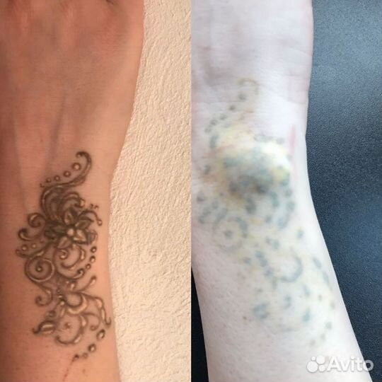 Лазерное удаление тату