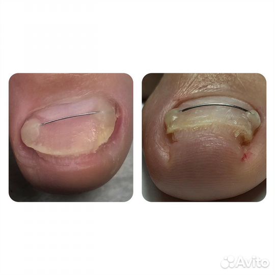 Вросшие ногти, бородавки, титановая нить, педикюр