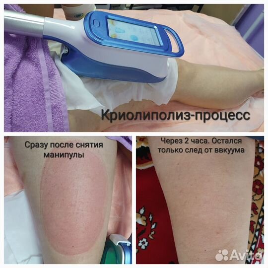 Криолиполиз