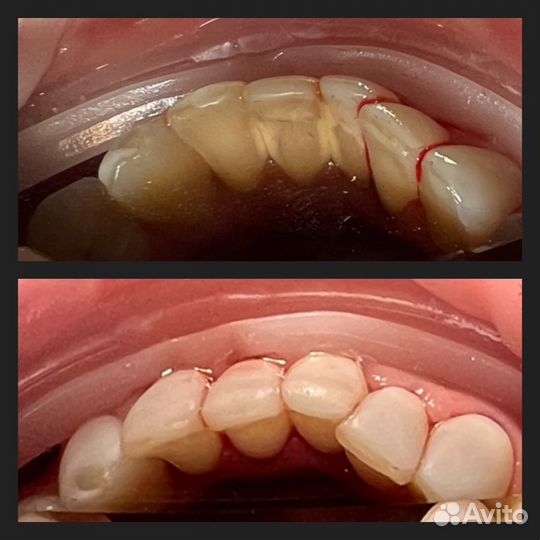 Купон на профессиональную гигиену рта
