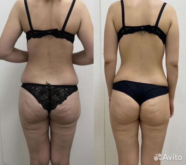 Массаж Антицеллюлитный,Лимфодренажный