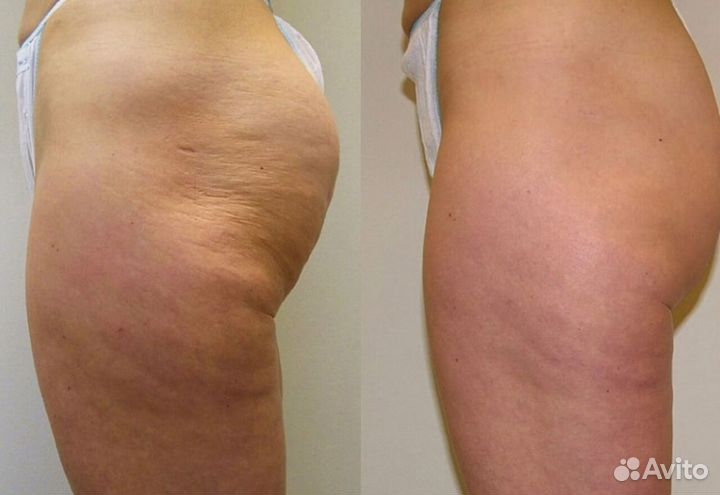 Аппарат ким 8