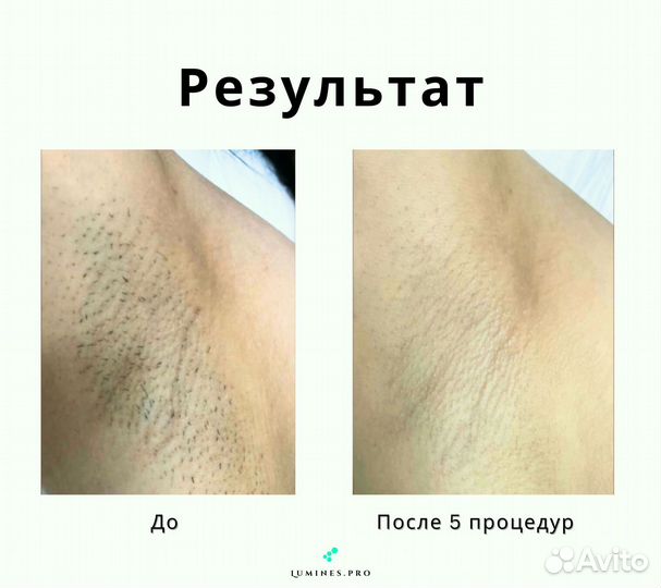 Диодный лазер для эпиляции Люминес Max’One 1200в