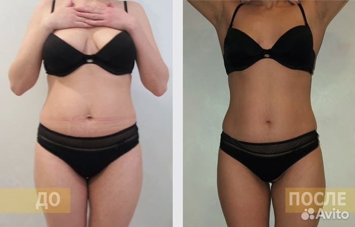 Аппаратная коррекция фигуры