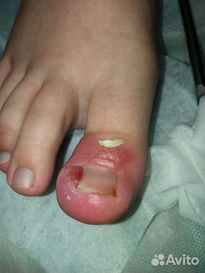 Подологический педикюр