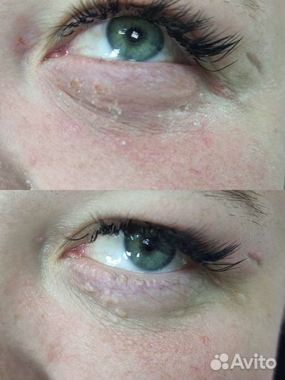 Удаление сосудов