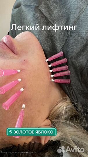 Модели на нитевой лифтинг