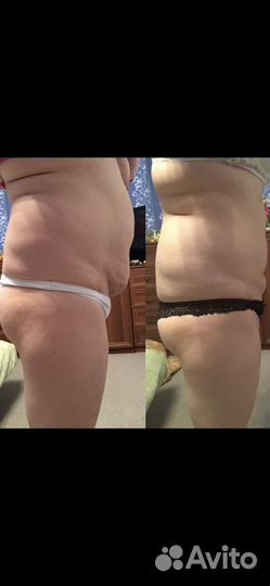 Антицеллюлитный массаж