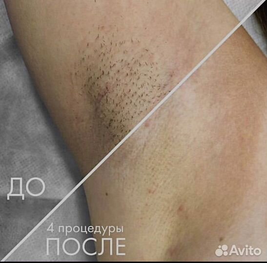 Лазерная диодная эпиляция