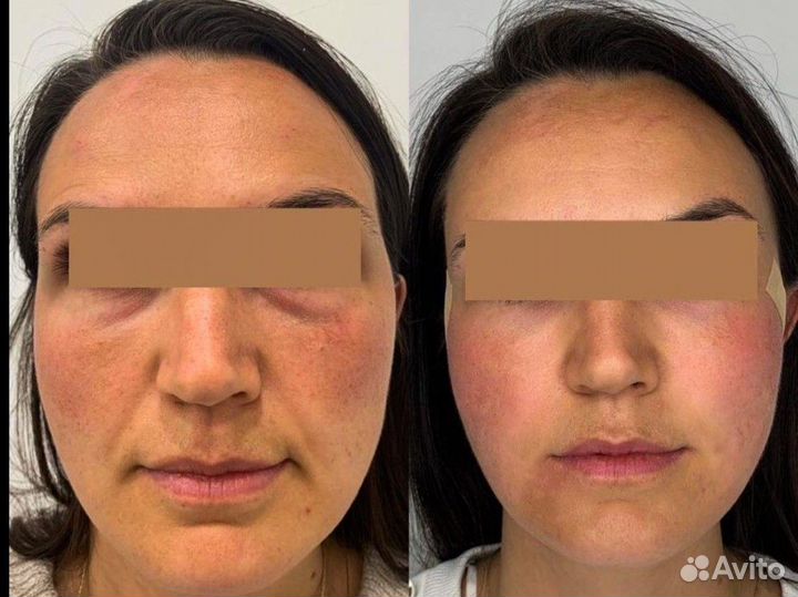 Модель на РФ лифтинг лица