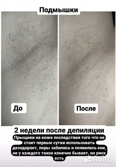 Депиляция женская и мужская