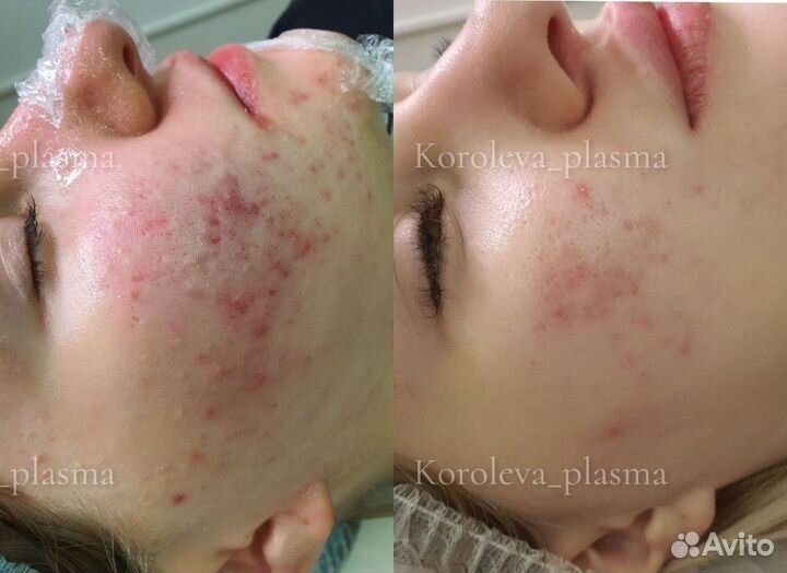 Холодная плазма