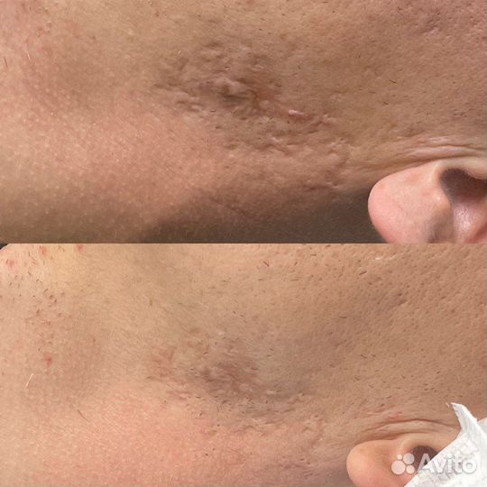 Удаление шрамов и рубцов