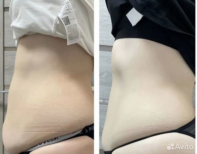 Плоский живот - размер за 1 процедуру в Волгограде