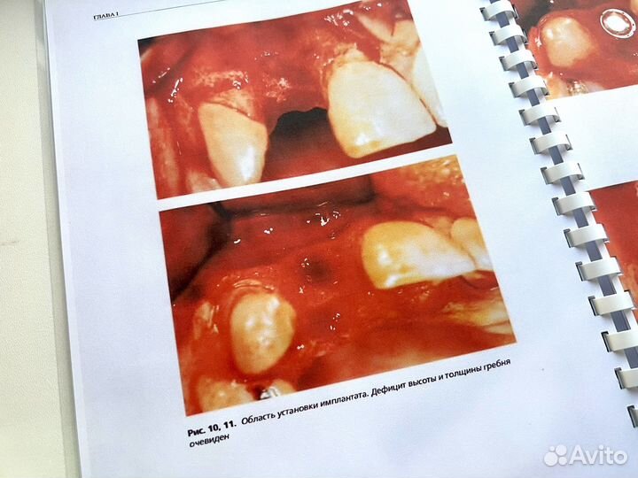 Передовые методики регенерации кости