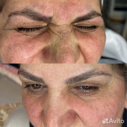 Уколы красоты