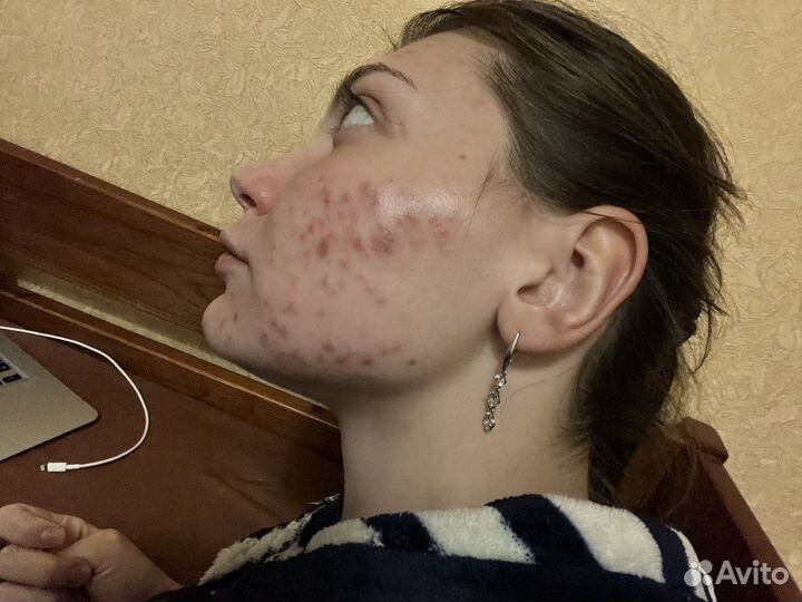 Лампа биоптрон zepter