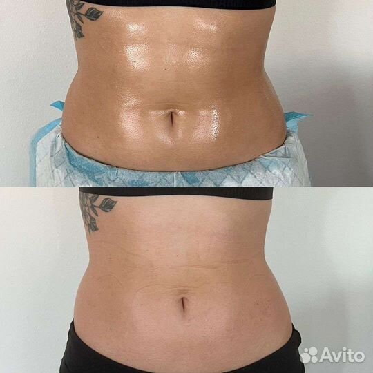 Массаж уз кавитация