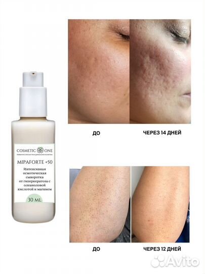 Сыворотка от гиперкератоза