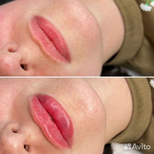 Увеличение губ