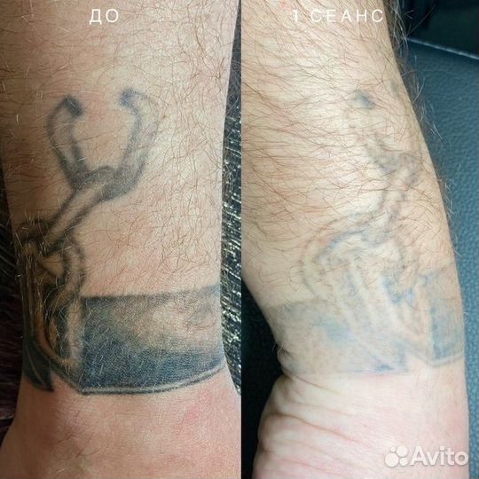 Лазерное удаление тату, татуажа бровей, губ
