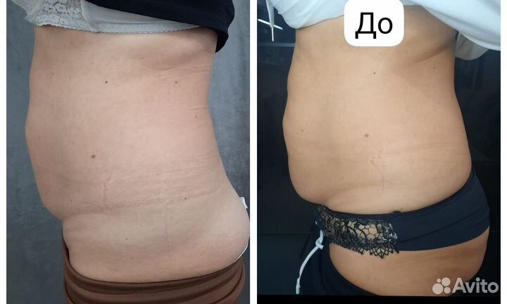 Коррекция фигуры exilis 360