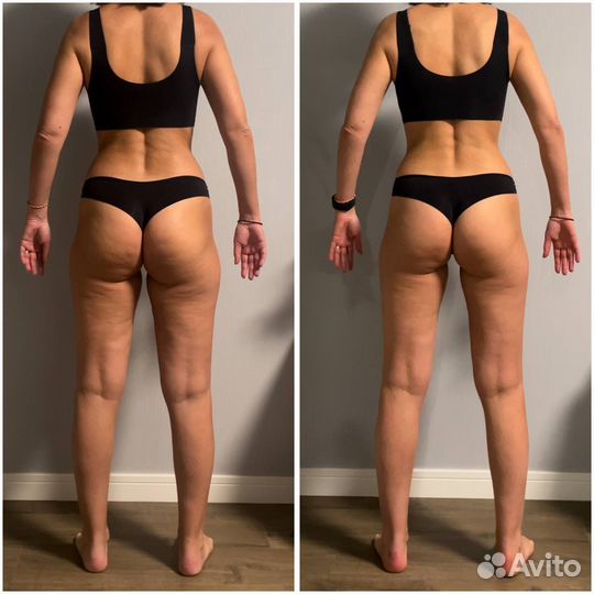 Антицеллюлитный массаж