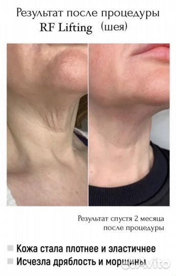 Микроигольчатый RF лифтинг