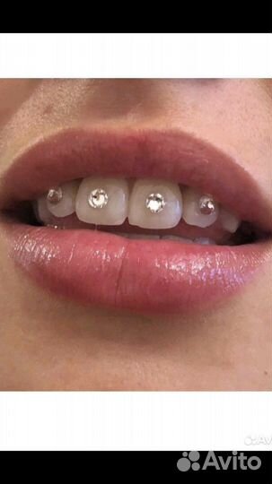Установка скайсов (кристаллов) на зубы