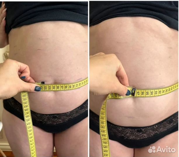 Плоский живот - размер за 1 процедуру