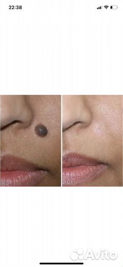 Удаление родинок, фибром, кератом, папиллом