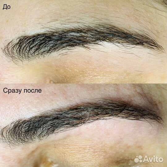 Электроэпиляция