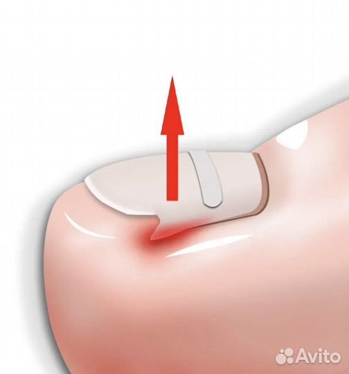 Удаление стержневых мозолей
