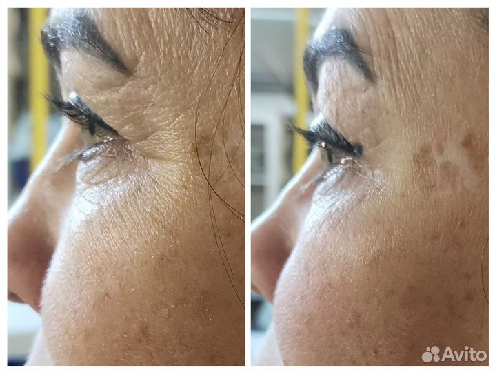 Массаж лица