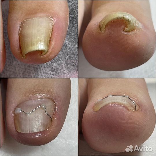 Подолог, вросший ноготь, грибок, мозоли, Липецк