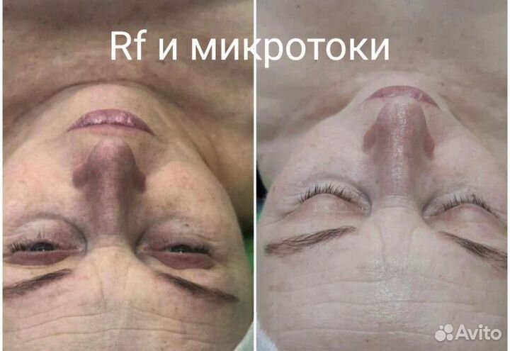 Коррекция Тела, лица Микротоки, кавитация,Вакуум