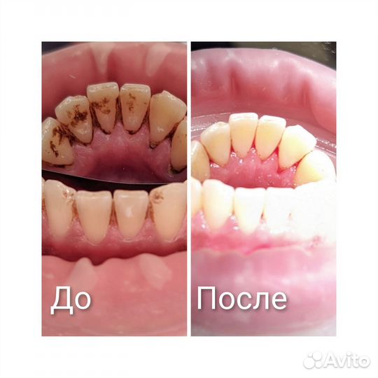 Сертификат на снятие зубных отложений