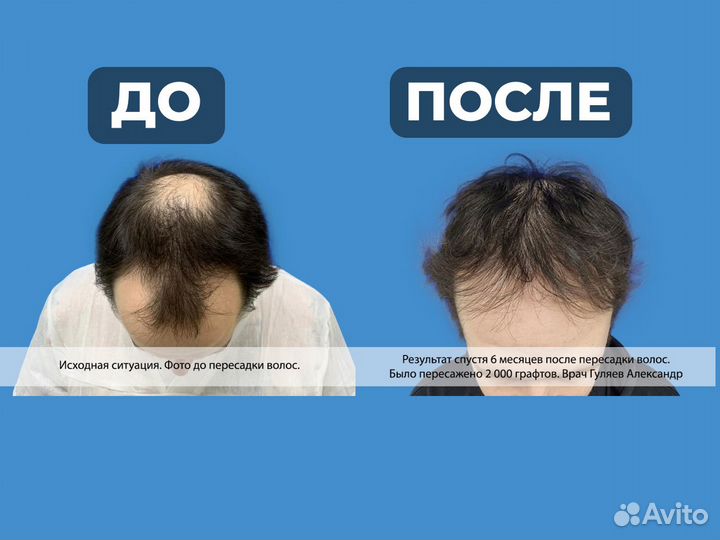 Пересадка волос для мужчин