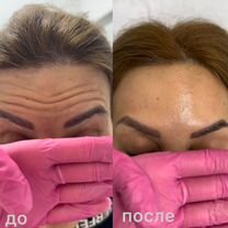 Ботокс в лицо: лоб+глаза от врача-косметолога, Химки