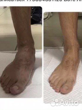 Лечение плоскостопия