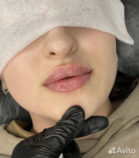 Увеличение губ, коррекция носа