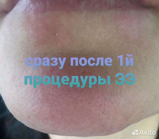 Электроэпиляция