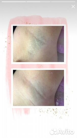 Депиляция воском: глубокое бикини